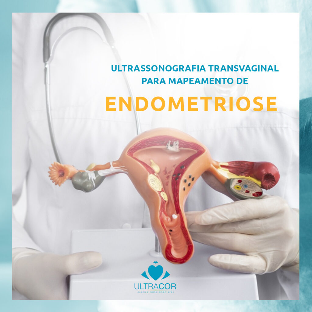Ultrassonografia Transvaginal para mapeamento de Endometriose - Ultracor